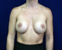breast_augmentation_photo_2701.JPG