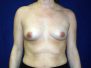 Breast augmentation photos 645*