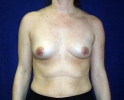 breast_augmentation_photo_upf_101.JPG