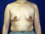 Breast augmentation photos 2654*