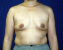 Breast augmentation photos heavy_301.JPG