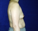Breast augmentation photos heavy_302.JPG