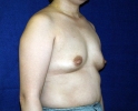 Breast augmentation photos heavy_303.JPG