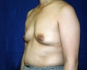 Breast augmentation photos heavy_304.JPG