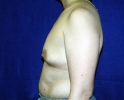 Breast augmentation photos_305.JPG