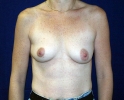 Breast_Augmentation_asd_107.JPG