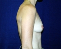 Breast_Augmentation_asd_109.JPG