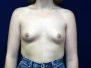 Breast augmentation photos 685*