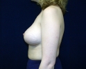 Breast augmentation photos _heavy_110.JPG
