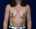 before-breast-augmentation-698.JPG