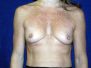 Breast augmentation photos 73*