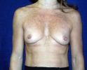 breast_augmentation_photo_outcomes_1001.JPG