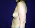 breast_augmentation_photo_hi_lo_105.JPG