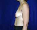 side-breast-augmentation-before-74.JPG