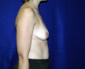 side-photos-breast-implants-before-74.JPG