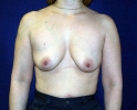 Breast augmentation photos vein201.JPG