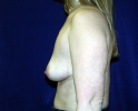 Breast augmentation photos vein205.JPG