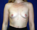 breast_augmentation_photo_asymmetry_91001.JPG