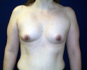 Breast implant pictures dev_401.JPG