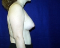 Breast implant pictures dev_404.JPG