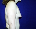 Breast implant pictures dev_408.JPG