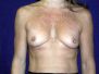 Breast augmentation photos 78*