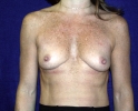 breast_augmentation_photo_hi_lo_301.JPG