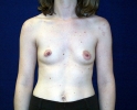 Breast_Augmentation_asd_201.JPG