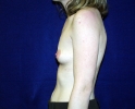 Breast_Augmentation_asd_205.JPG