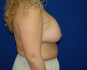 breast_augmentation_photo_imfr104.JPG