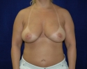 breast_augmentation_photo_imfr106.JPG