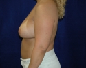 breast_augmentation_photo_imfr108.JPG