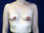 Breast implant pictures 84*