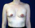 Breast implant pictures dev_301.JPG