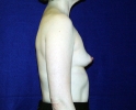 Breast implant pictures dev_303.JPG