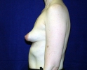 Breast implant pictures dev_305.JPG
