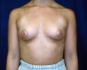 before-breast-augmentation-841.JPG