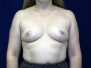 Breast augmentation photos 1987*