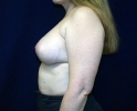 Breast augmentation photos _heavy_205.JPG