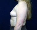 Breast augmentation photos _heavy_208.JPG