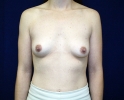 Breast augmentation photos gap_406.JPG