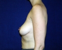 breast_augmentation_photo_ribs_508.JPG