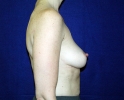 breast_augmentation_photo_ribs_511.JPG
