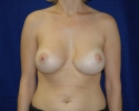 breast_augmentation_photo_deflation401.JPG