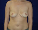 breast_augmentation_photo_deflation406.JPG