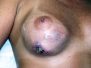 Breast implant infection 1*