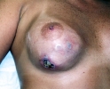breast_augmentation_photo_infection_102.JPG