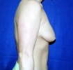 Breast lift pictures _1007.JPG