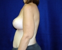 Breast lift pictures 1307.JPG