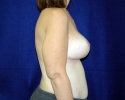 Breast lift pictures 1309.JPG